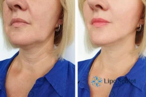 Double chin before and after Hi-Fu treatment 4 Book your double chin treatment Guildford today! We are here to help!