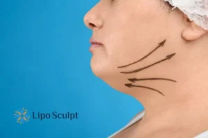 Double chin before and after Hi-Fu treatment 3 Boost your confidence with a Double chin treatment Guildford