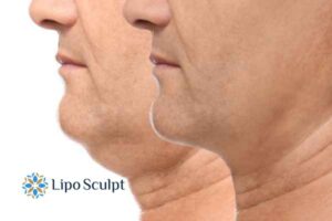 Double chin before and after Hi-Fu treatment 2 Double chin treatment Guildford from Lipo Sculpt - feel more confident today!
