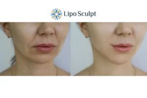 Explaining Morpheus8 And What It Can Do For You 2 Do you want to boost your self confidence? Give Morpheus8 Guildford a try today!