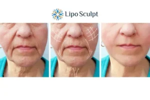 Explaining Morpheus8 And What It Can Do For You 3 Boost your confidence with Morpheus8 Guildford call our team today!