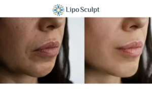 Explaining Morpheus8 And What It Can Do For You 4 Morpheus8 Guildford the best results - call our team today!