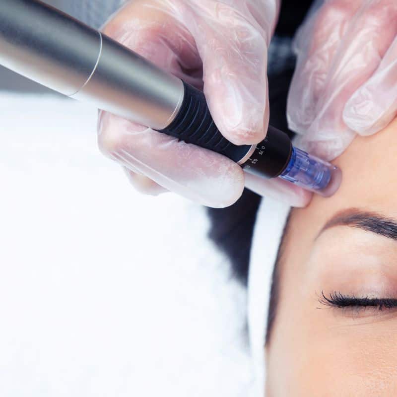 Morpheus8 treatment Guildford from Lipo Sculpt - Book in today!